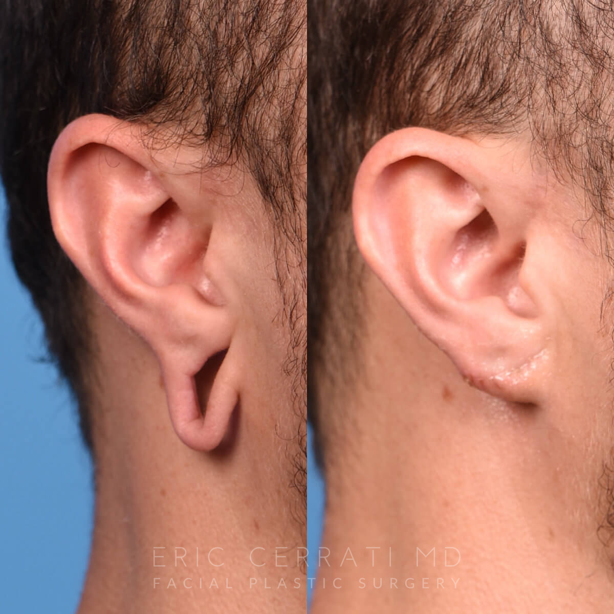🥇 Treating Stretched or Torn Earlobes
